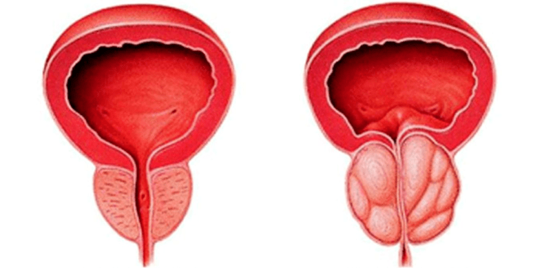 Normal and inflamed prostate. 